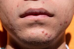 derma