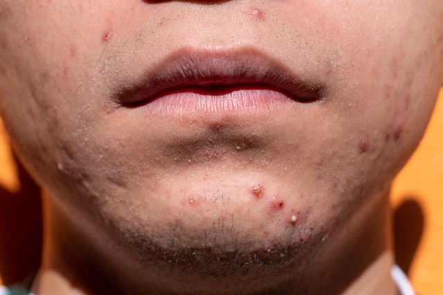 derma